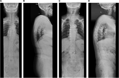 Correlation Between Different Sagittal Parameters in Patients With Degenerative Kyphosis